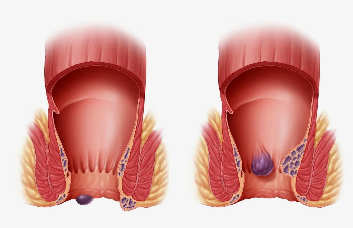 Геморрой — заболевание прямой кишки