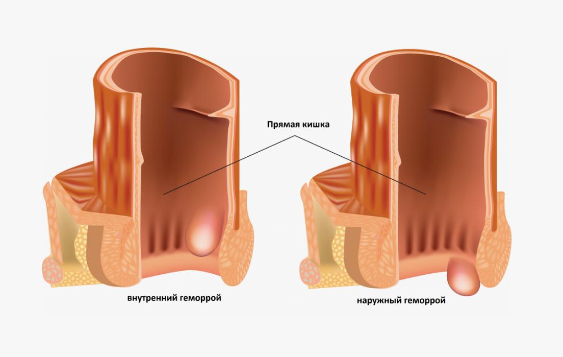 Лечение внутреннего геморроя 1