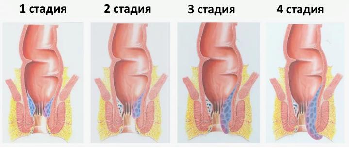 Лечение внутреннего геморроя 2